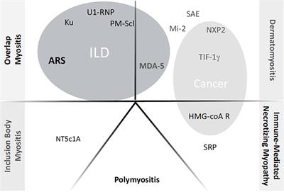 Inflammatory Myopathy-Related Interstitial Lung Disease: From Pathophysiology to Treatment